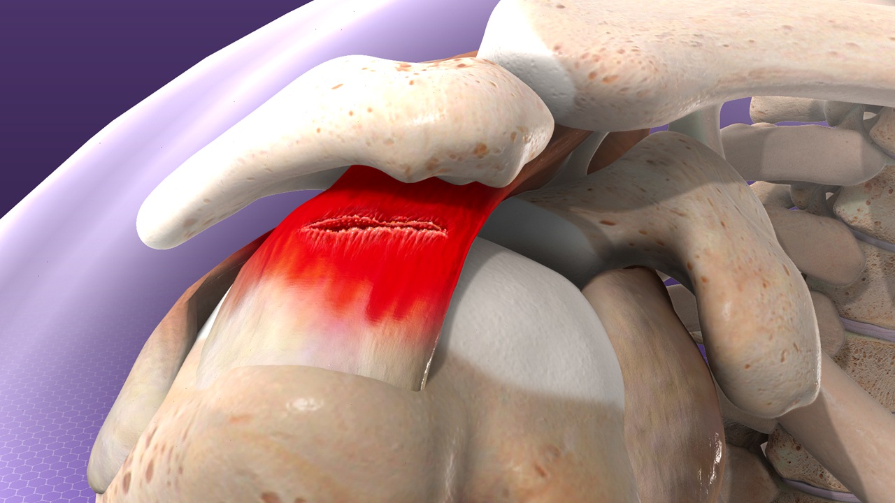Reduce Your Rotator Cuff Pain with Houston’s Top Orthopedic Specialists